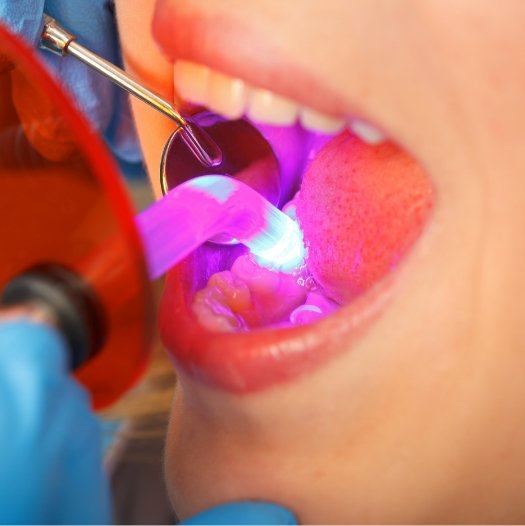 Close up of dental patient getting composite bonding on a tooth