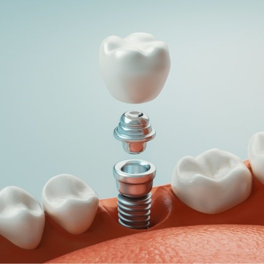 Illustrated dental implant in Dallas replacing a missing tooth