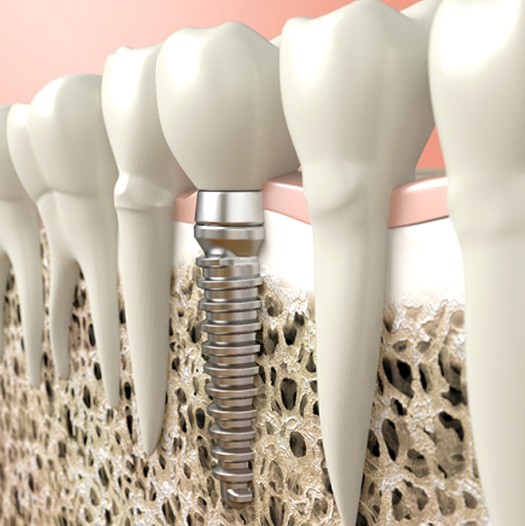 Digital illustration of a dental implant