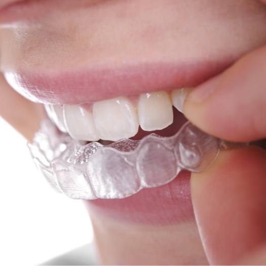 Close up of person placing Invisalign tray over their teeth