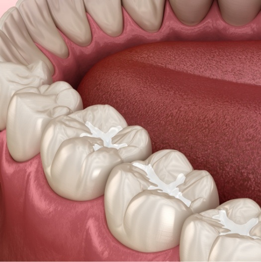 Illustrated row of teeth with tooth colored fillings