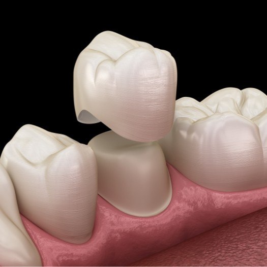 Illustrated dental crown being placed over a tooth