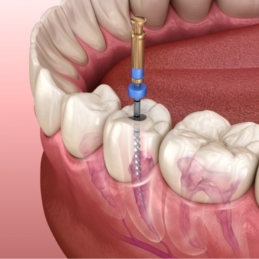 Illustrated dental tool cleaning the inside of a tooth