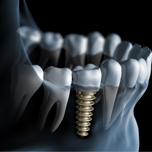 Illustrated x ray of a person with a dental implant replacing a missing tooth