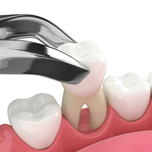 Illustration of tooth being extracted