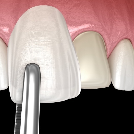 Illustrated veneer being placed onto upper front tooth